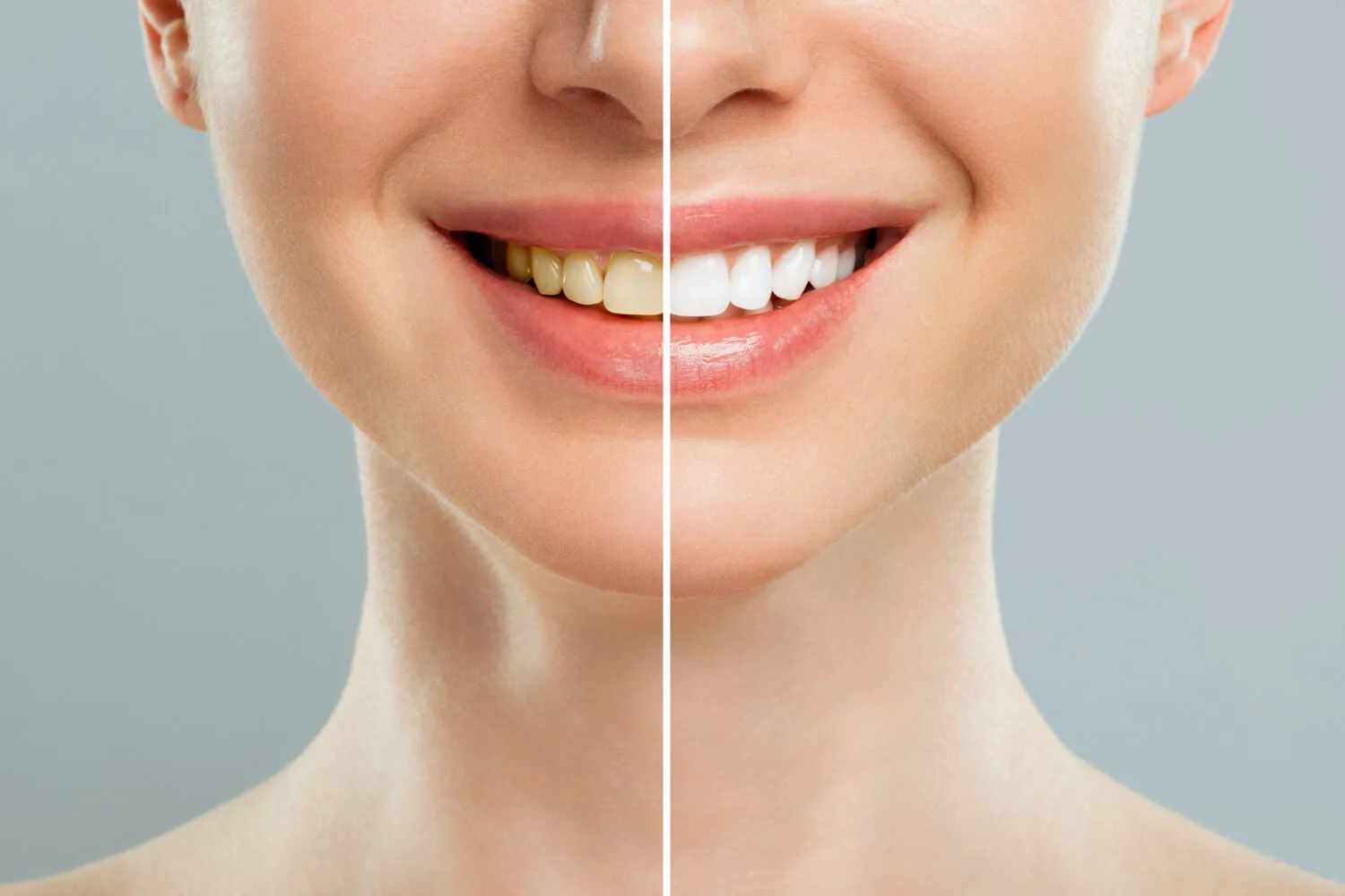 Before & After Teeth Whitening