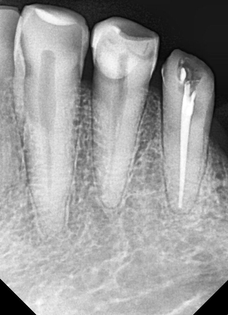 Root Canal Procedure X-Ray 2